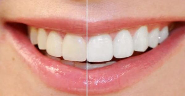 小白老师Photoshop培训:PS人物肖像全面修饰教程,百度云 免费下载(价值99元)插图1 PS高级美白牙齿 视频截图